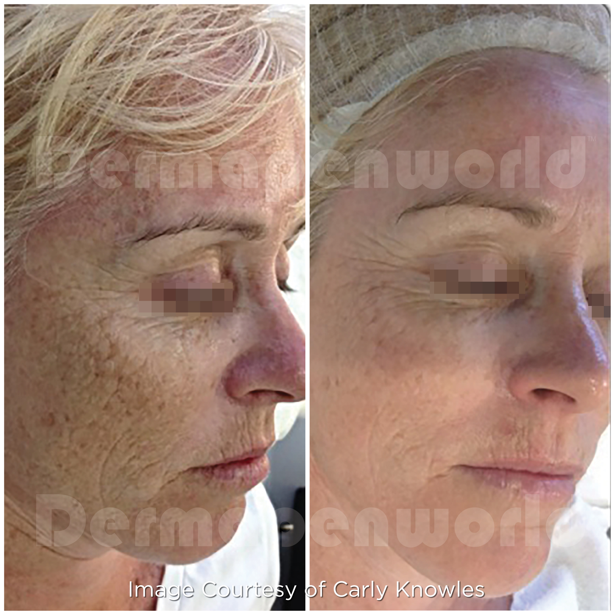 Dermapen before and after