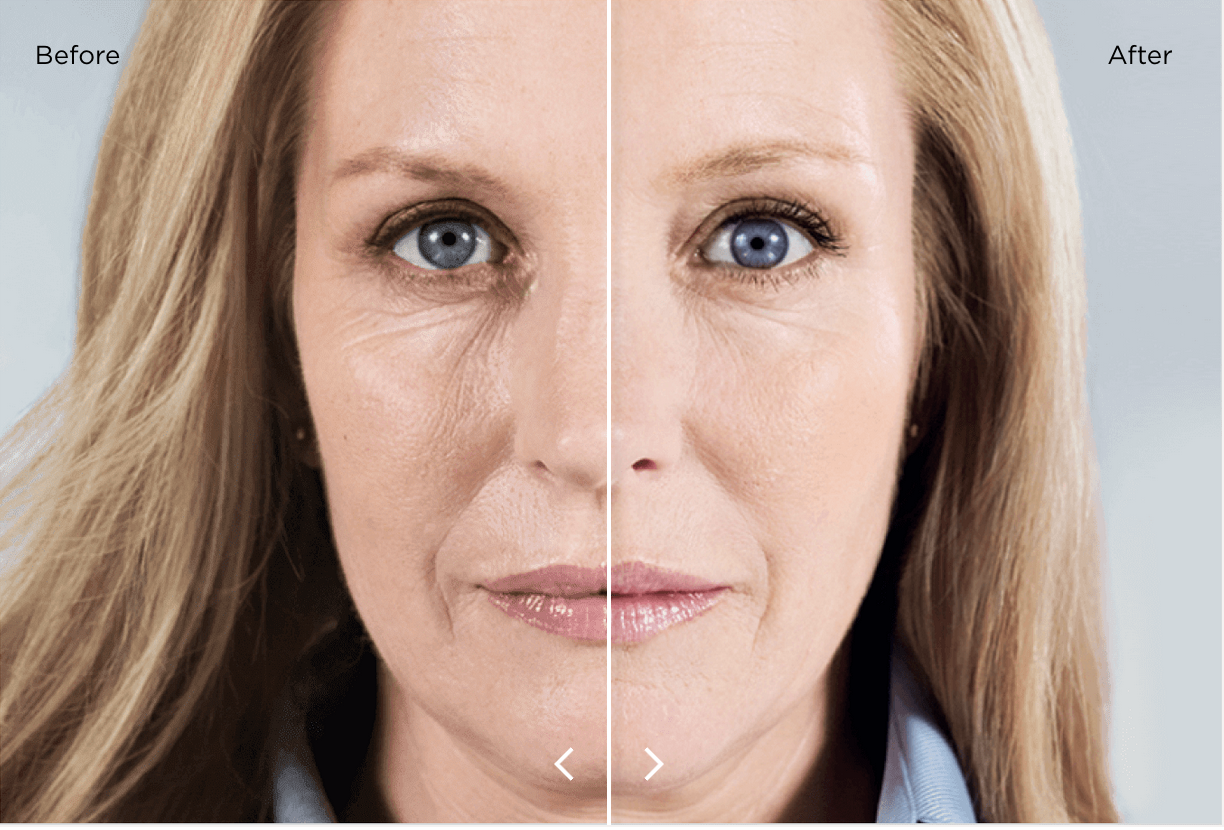 Before adn after Sculptra