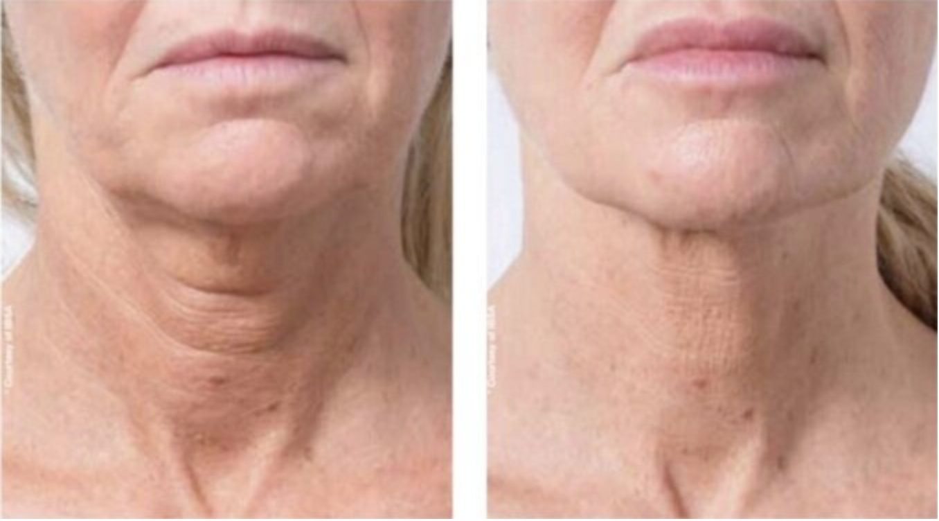 Before and after CACI